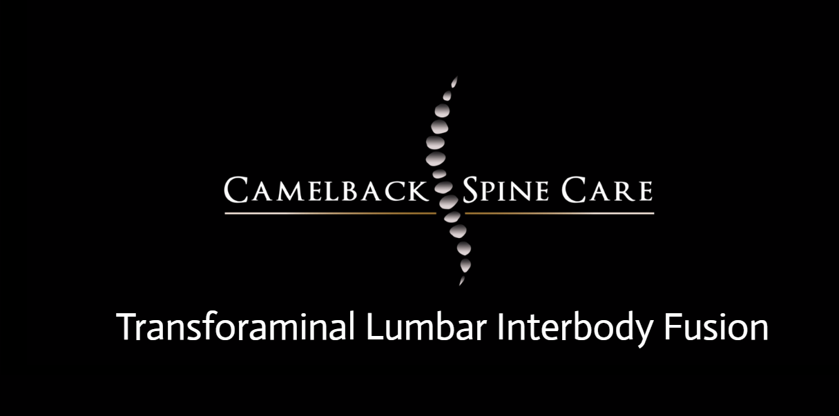 Transforaminal Lumbar Interbody Fusion